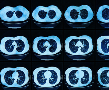 ct lung screening